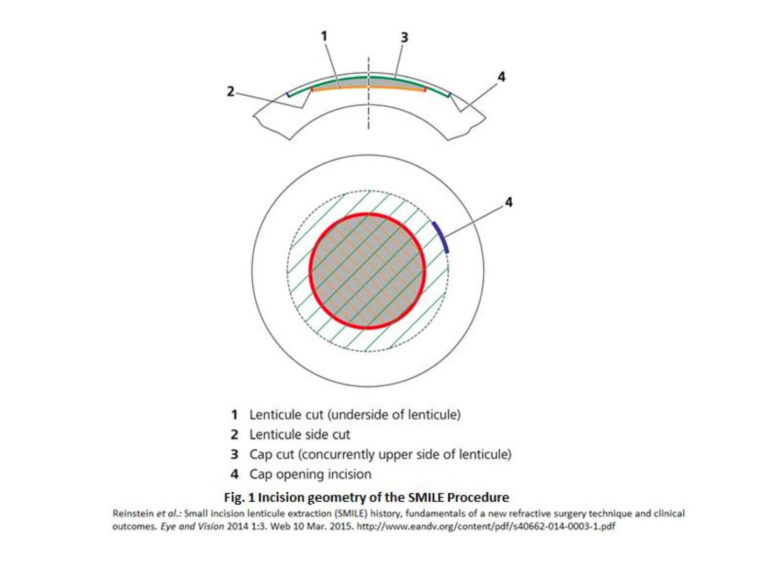 LASIK vs SMILE Choosing the Best Corrective Surgery Tech